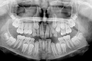 Панорамный рентген снимок всех зубов
