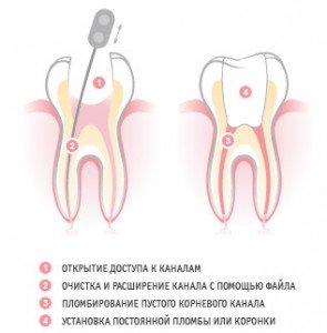 Пломбирование корневых каналов без боли