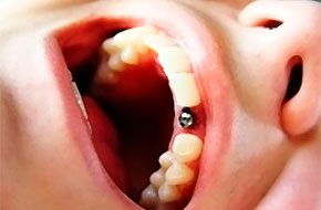 Экспресс-имплантация зубов