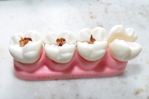 Детский кариес и чем он грозит?