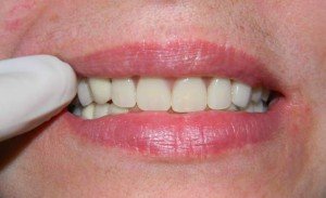 Как делают съемные зубные протезы?