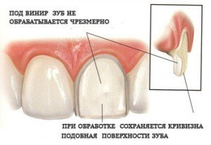 Виниры на зубы в Украине