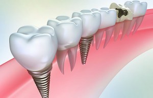 Зубные импланты. Показания и противопоказания